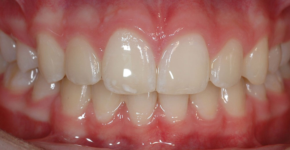 Dentista Bleaching Cernusco