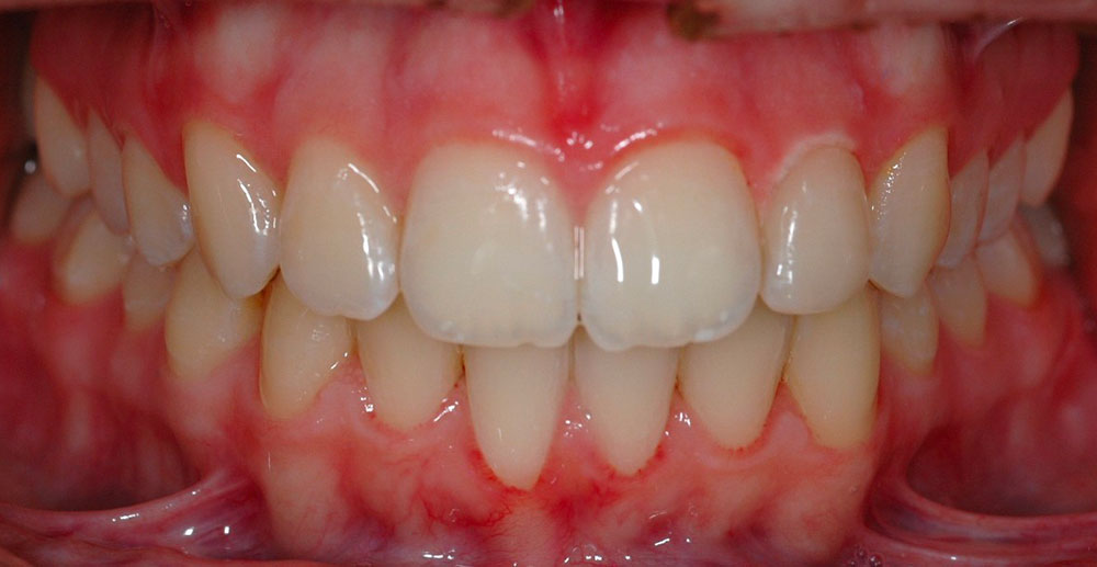 Dent Bleaching Cernusco